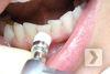 Полировка зуба профилактической пастой