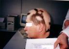 Лечение облысения и выпадения волос.   Клиника хрономедицины «Резонанс».